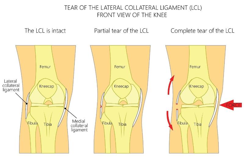 Lateral Collateral Ligament